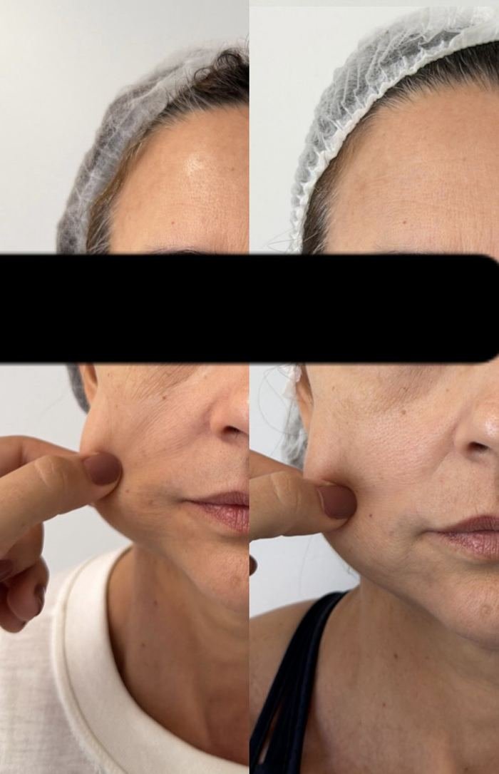 Antes e depois de bioestimulador de colágeno na face, olhos cobertos por tarja