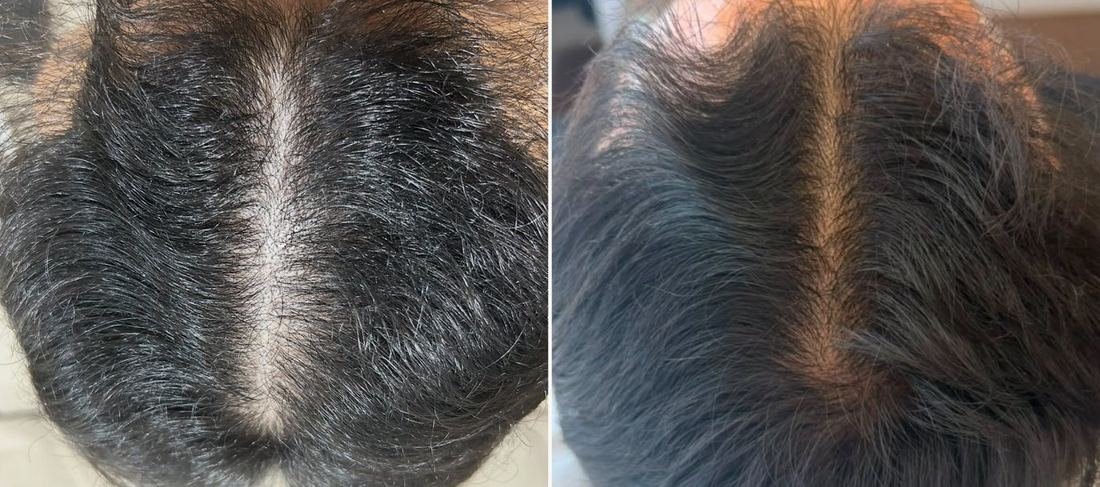Antes e depois do couro cabeludo, vista do topo da cabeça